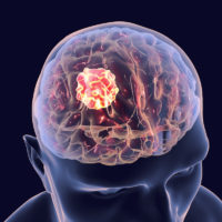 Brain cancer onset from toxic exposure